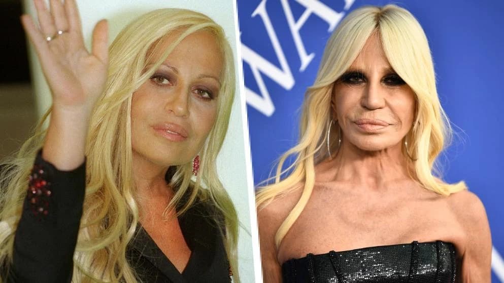 Donatella Versace priznaje jedino korištenje botoksa