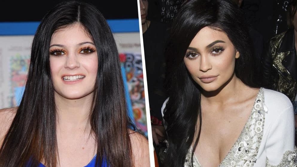 Kylie Jenner  priznaje jedino da je napumpala usne