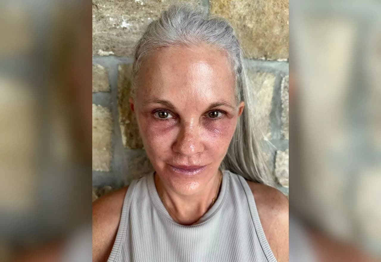 Lisa 2 mjeseca nakon operacije