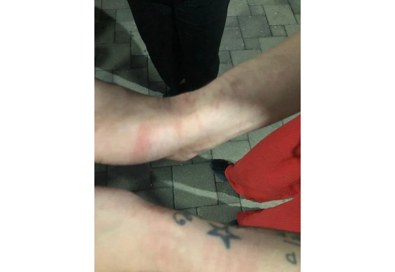 Zadobivene ozljede pri privođenju