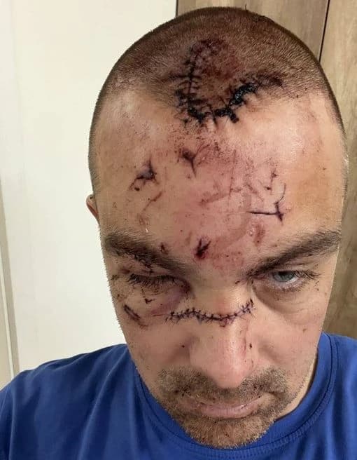 Objavljena fotografija muškarca povrijeđenog u tučnjavi s košarkašima Partizana