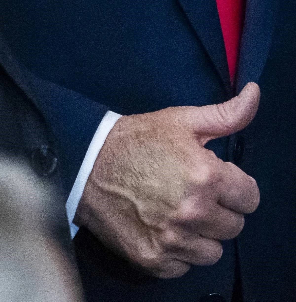 Donald Trump boluje od kronične venske insuficijencije