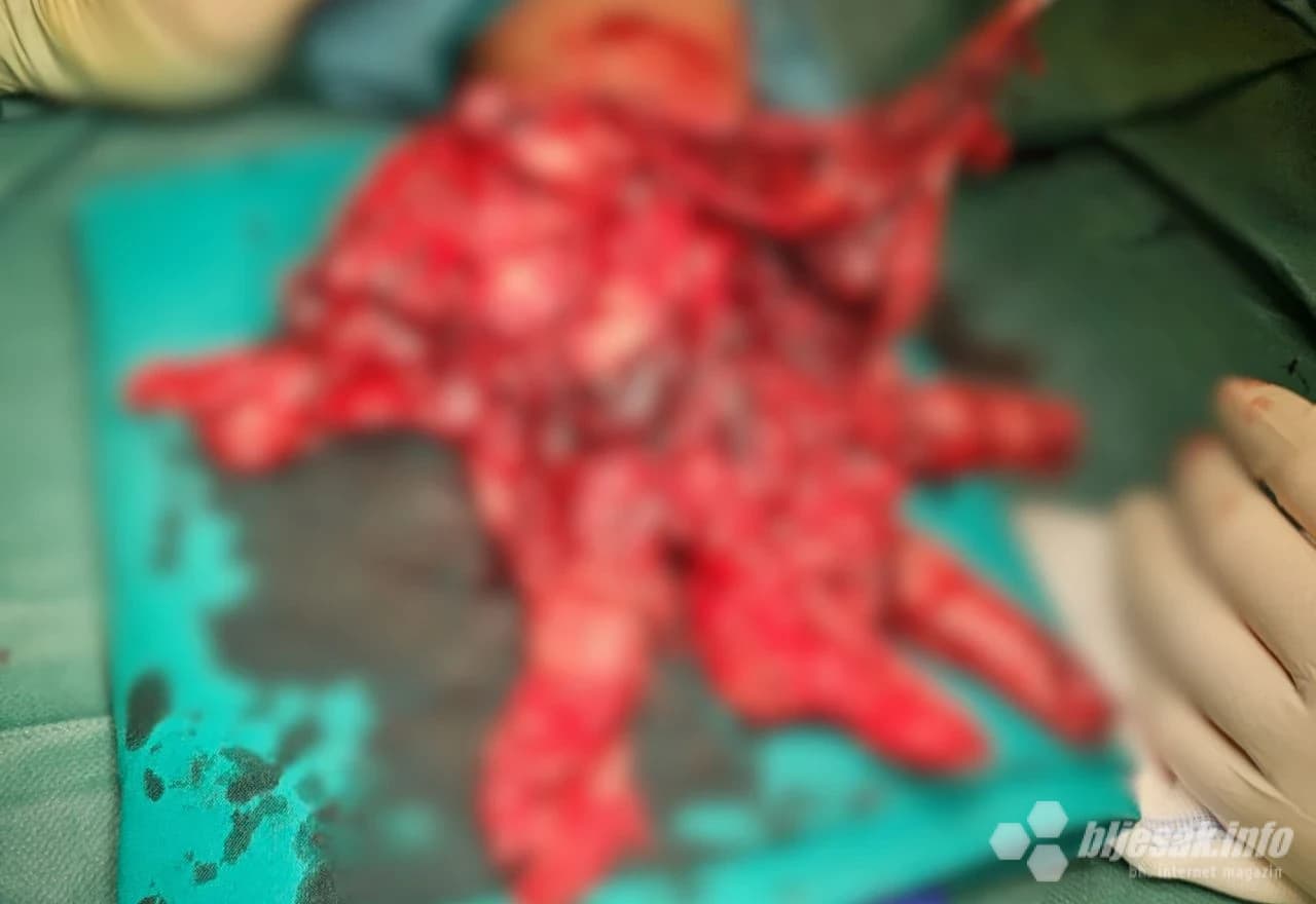 Najteža operacija je trajala osam sati.