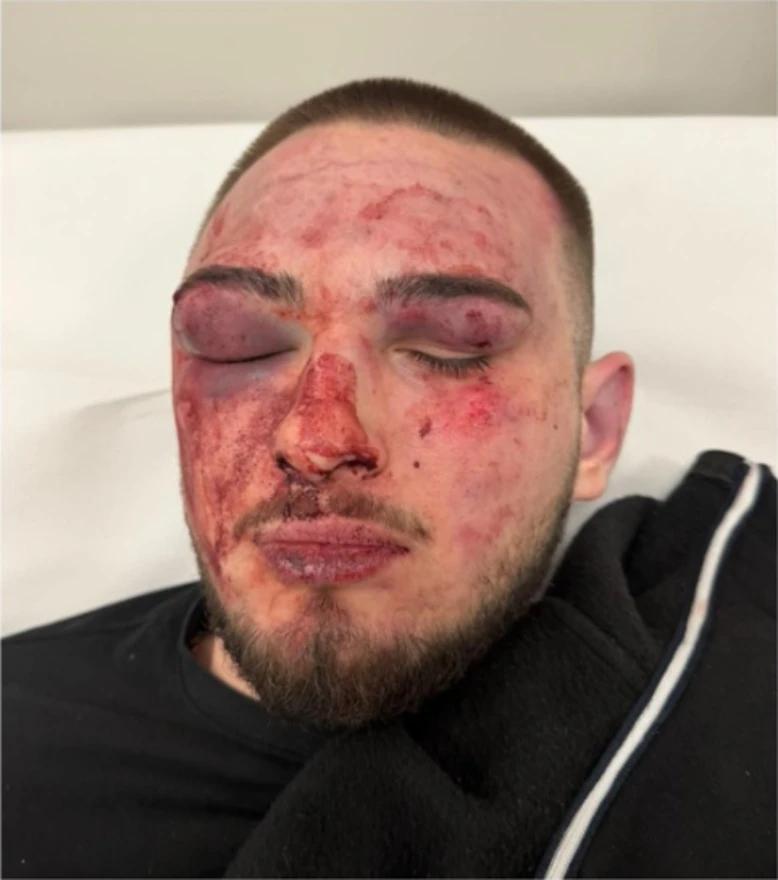 Napadnuti 16-godišnjak