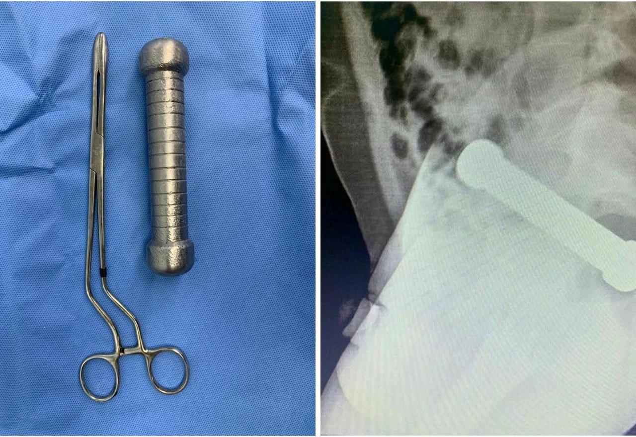 Uteg od 2 kg bio u rektumu muškarca