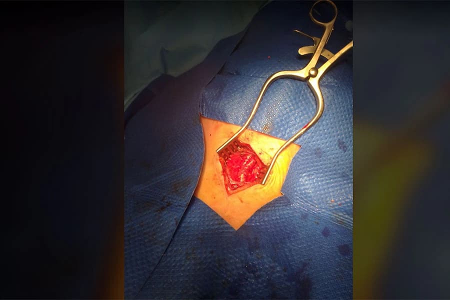 U Poliklinici Vitalis je izvedena prva operacija karotida u lokalnoj anesteziji