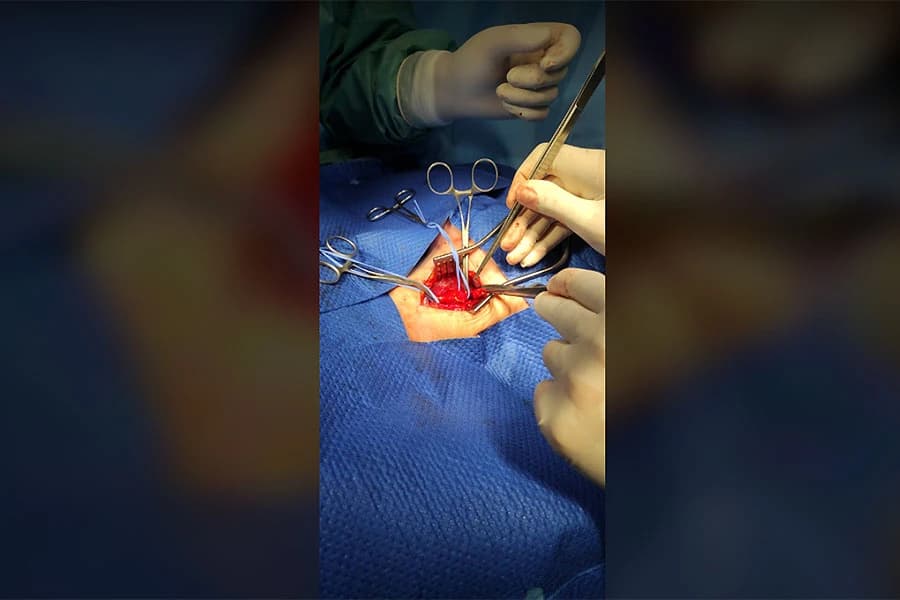 U Poliklinici Vitalis je izvedena prva operacija karotida u lokalnoj anesteziji